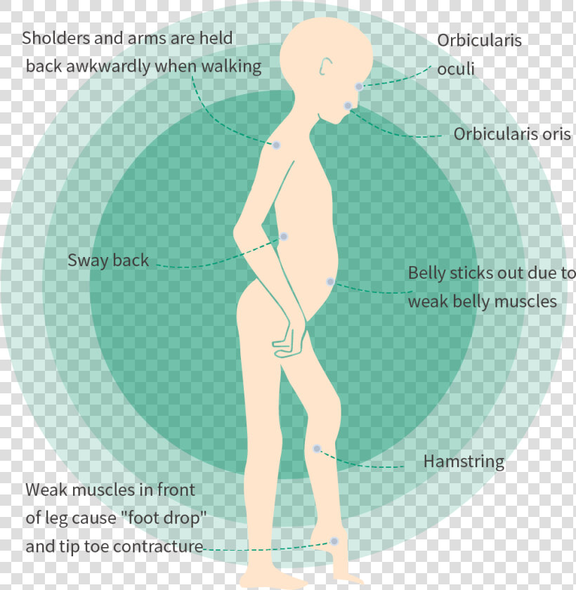 Muscles Affected By Fshd  HD Png DownloadTransparent PNG
