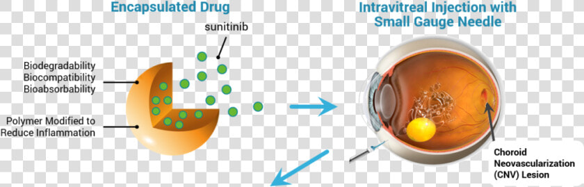 Intravitreal Injection  HD Png DownloadTransparent PNG