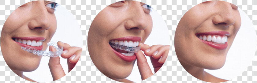 Invisalign   Invisalign Braces In Dubai  HD Png DownloadTransparent PNG