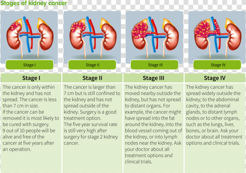 Kidney Tumor Stages  HD Png DownloadTransparent PNG