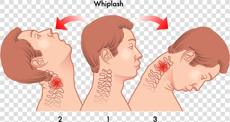 Head Neck Whiplash   Whiplash Injury  HD Png DownloadTransparent PNG
