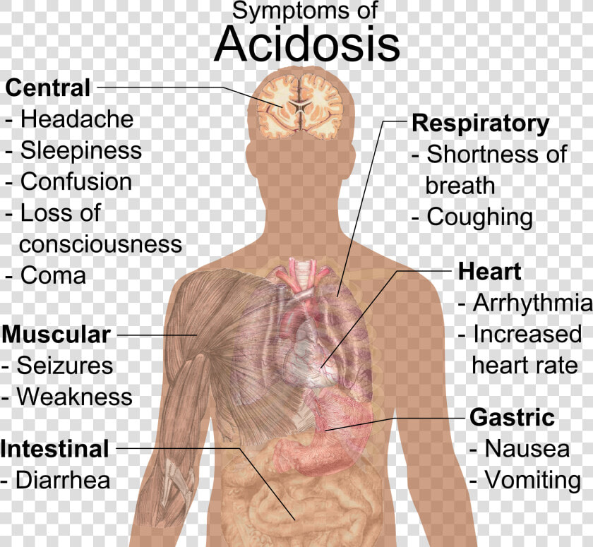 Symptoms Of Acidosis  HD Png DownloadTransparent PNG