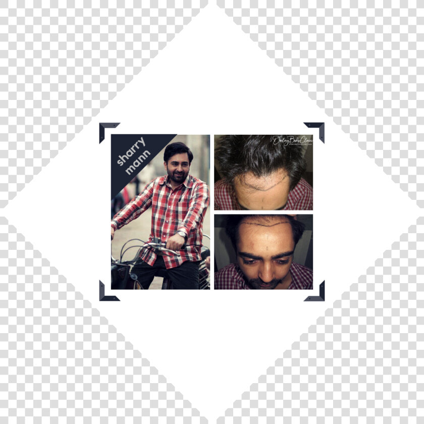 Sharry Mann Hair Transplant   Coffee  HD Png DownloadTransparent PNG