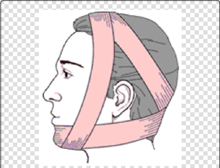 Tmj Dislocation Bandage  HD Png DownloadTransparent PNG