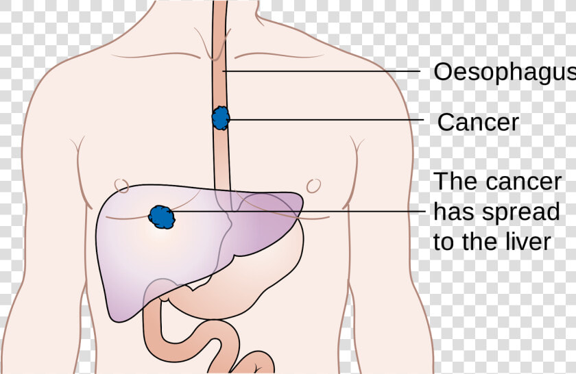 Am Worried About Esophagus Cancer  HD Png DownloadTransparent PNG