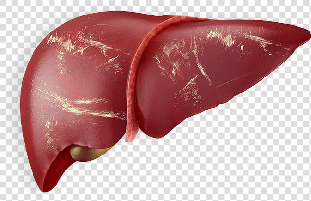 Liver Png Page   Chronic Liver With Hepatitis B  Transparent PngTransparent PNG