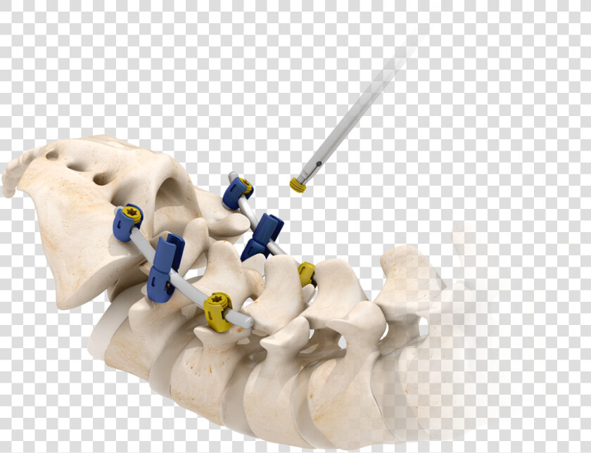 Picture   Screw Degenerative Spine  HD Png DownloadTransparent PNG