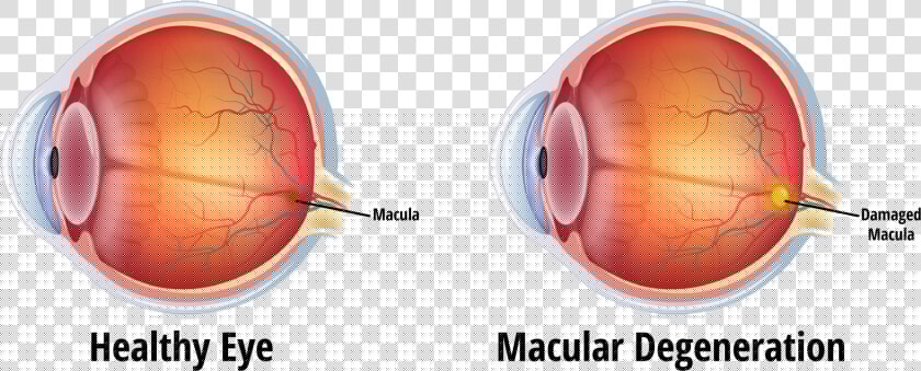 Blindness Caused By Glaucoma  HD Png DownloadTransparent PNG