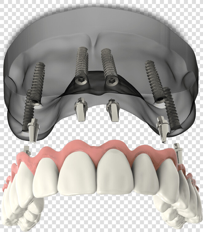 Full Arch Dental Implants Model Falls Church  Va   Bicycle Pedal  HD Png DownloadTransparent PNG