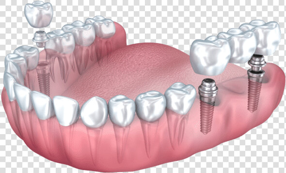 Dental Implant Benefits Summit Nj   Multiple Dental Implants  HD Png DownloadTransparent PNG