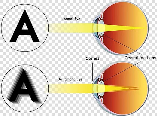 Astigmatism See  HD Png DownloadTransparent PNG