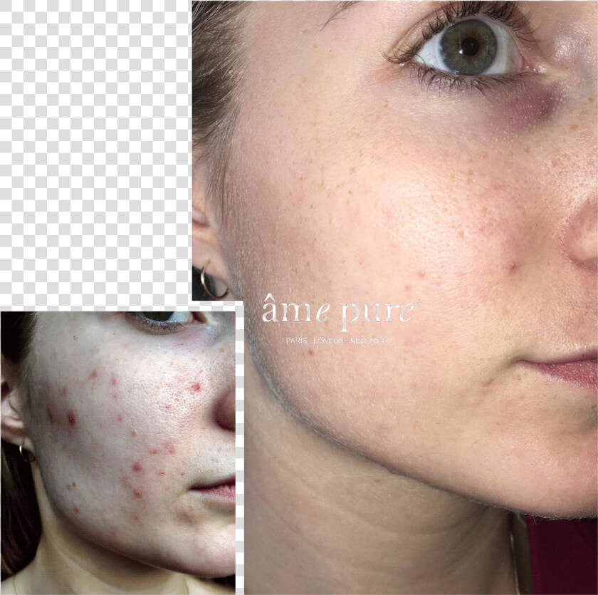 Ame Pure Before And After  HD Png DownloadTransparent PNG