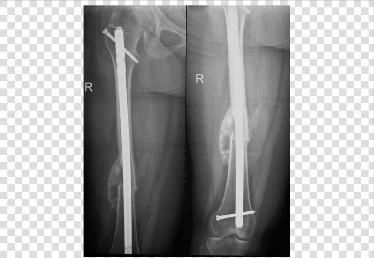 Showing X Ray Of Femur With Accelerated Fracture Healing   Healed Femur X Ray  HD Png DownloadTransparent PNG