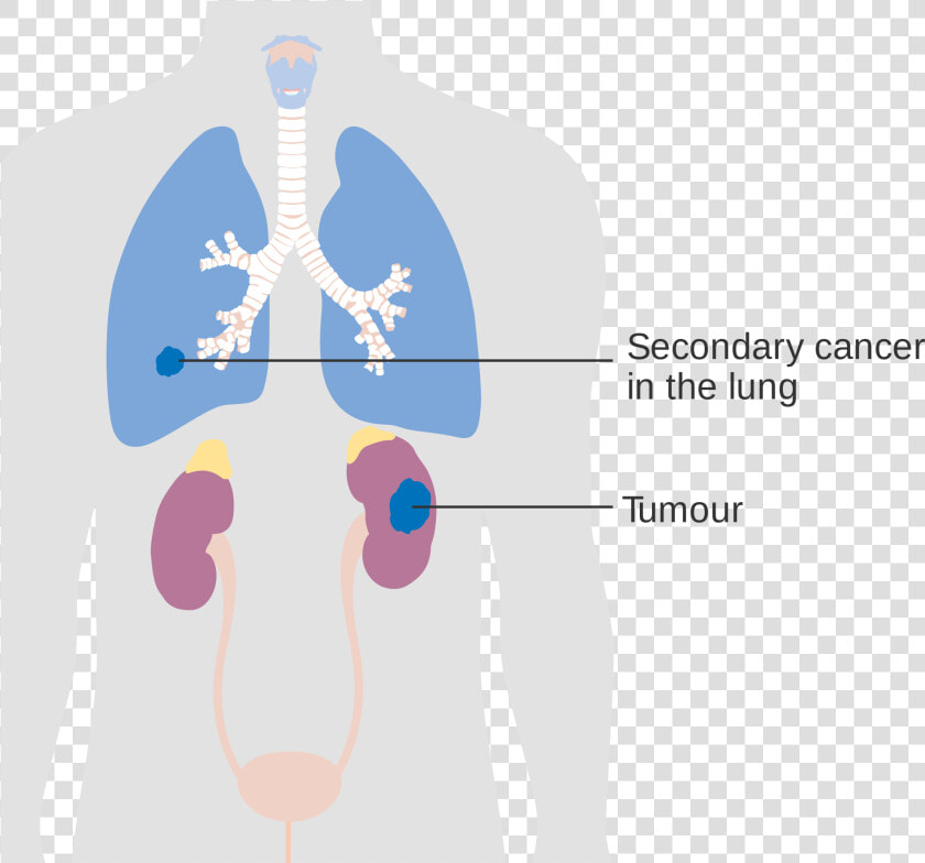 Kidneys Png   Png Download   Secondary Lung Tumor  Transparent PngTransparent PNG