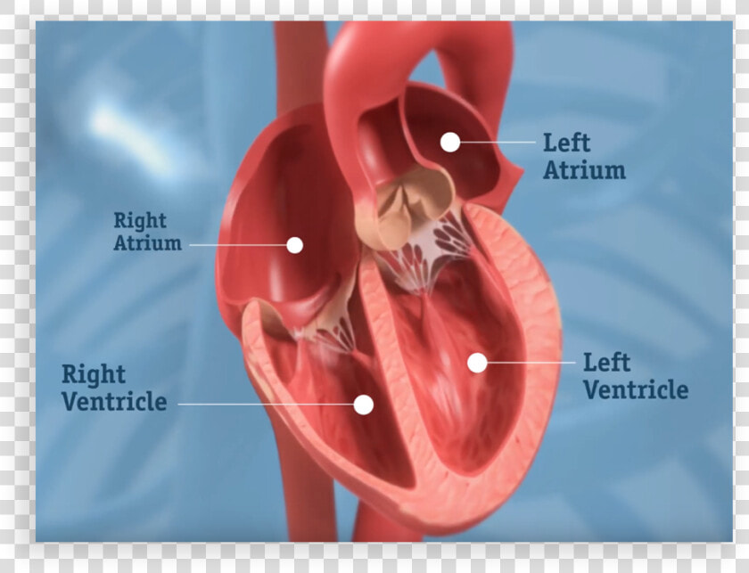 Get More Clarity About Your Dvt Treatment Options   Severe Aortic Stenosis  HD Png DownloadTransparent PNG