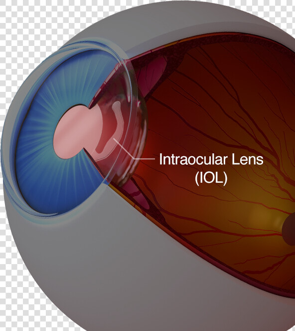 A Diagram Of An Eye With An Intraocular Lens   Intraocular Lens  HD Png DownloadTransparent PNG