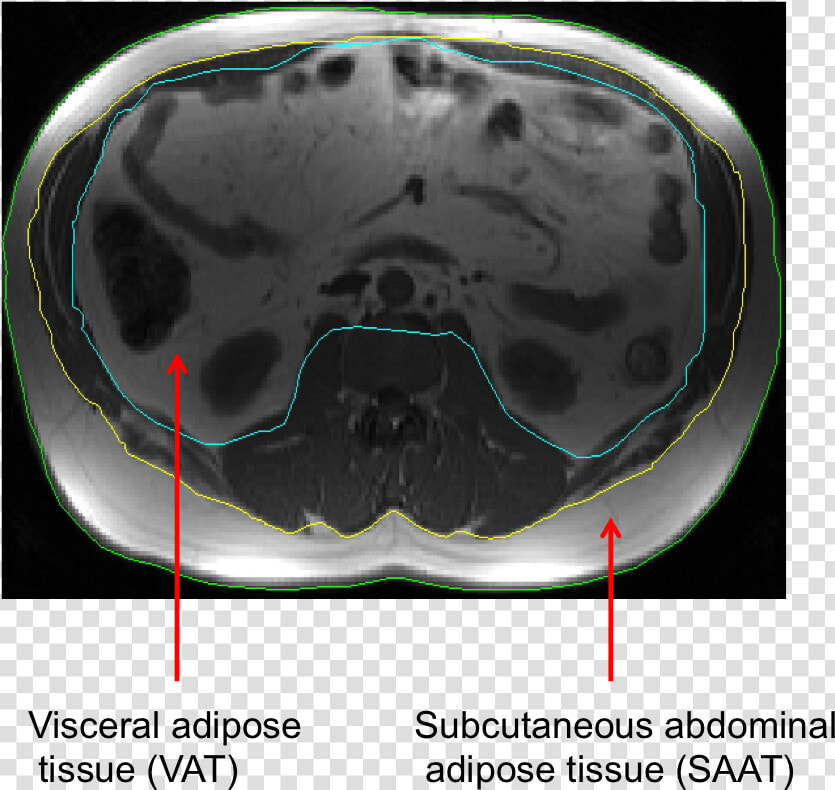 V Fat   Computed Tomography  HD Png DownloadTransparent PNG