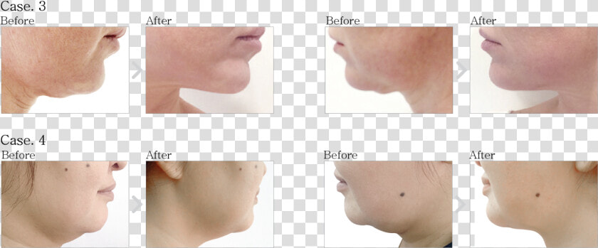 Prostrolane Inner B Before And After  HD Png DownloadTransparent PNG