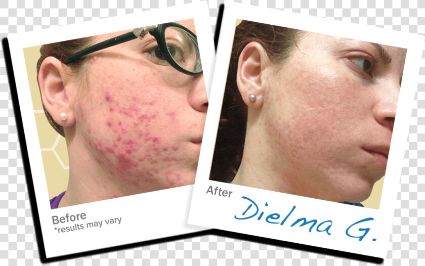 Dielma Acne Trial   Crew Cut  HD Png DownloadTransparent PNG
