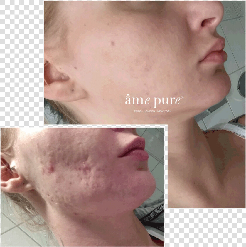Ame Pure Before And After  HD Png DownloadTransparent PNG