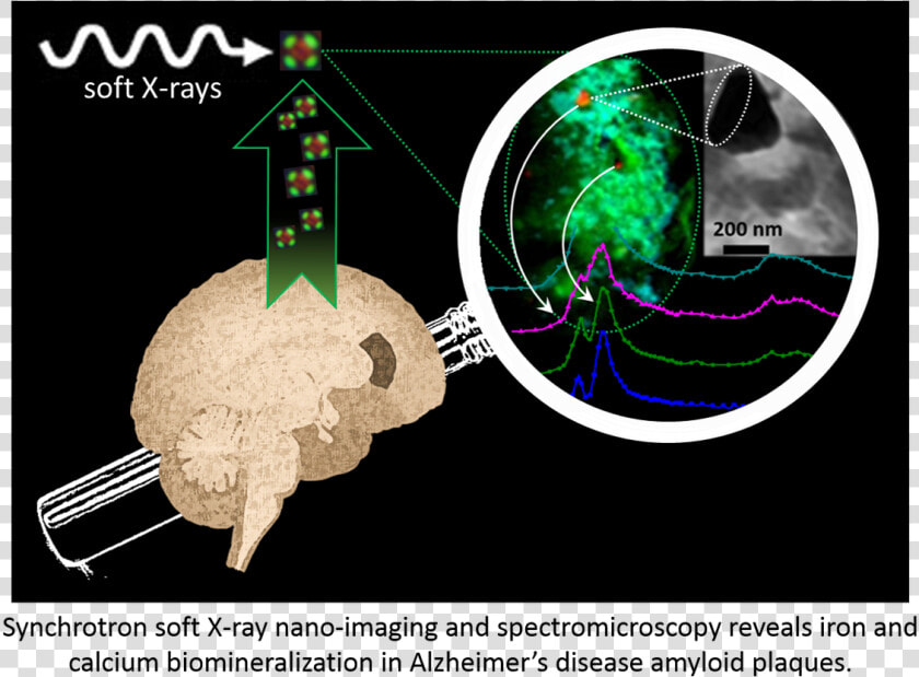 Iron Alzheimer  39 s Disease  HD Png DownloadTransparent PNG