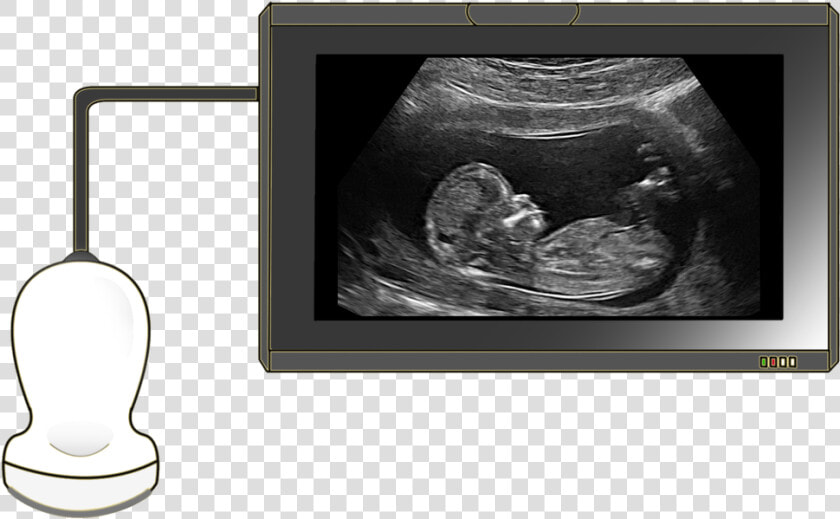 Ultrasound   Polyhydramnios Ultrasound  HD Png DownloadTransparent PNG