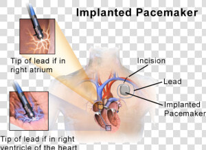 Implantable Cardioverter Defibrillators  HD Png Download