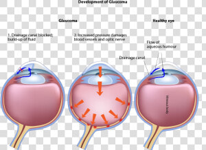 Development Of Glaucoma   Glaucoma Vs Healthy Eye  HD Png Download