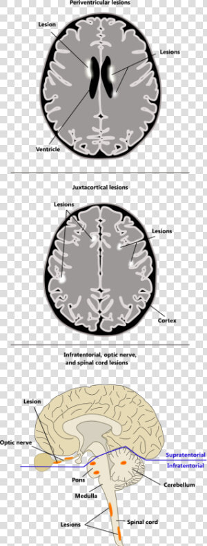Periventricular Juxtacortical Infratentorial Spinal  HD Png Download