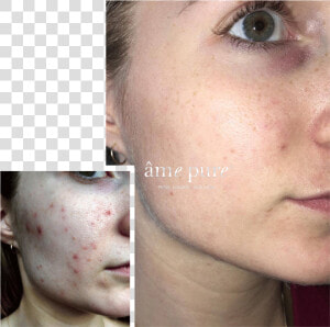 Ame Pure Before And After  HD Png Download