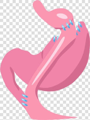 Gastric Bypass  HD Png Download