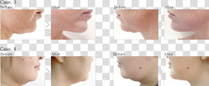 Prostrolane Inner B Before And After  HD Png Download