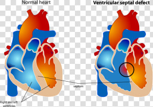 Small Ventricular Septal Defect  HD Png Download
