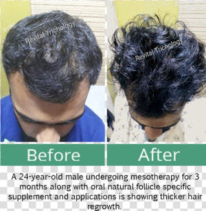 Hair Loss In Men   Lace Wig  HD Png Download