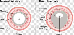 Bronchiectasis Loss Of Cilia  HD Png Download