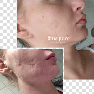 Ame Pure Before And After  HD Png Download