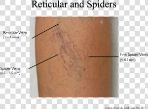 What Not To Treat Hits The Spot   Spider Vein Treatment Cutera  HD Png Download