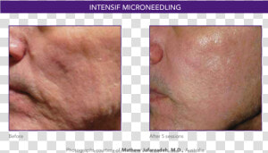 Scarring 1   Scar  HD Png Download