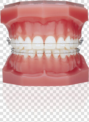 Typodont With Braces  HD Png Download