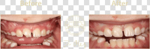 425 Before After Cosmetic22   Tongue  HD Png Download