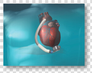 Heartmate 3 Abbott  HD Png Download