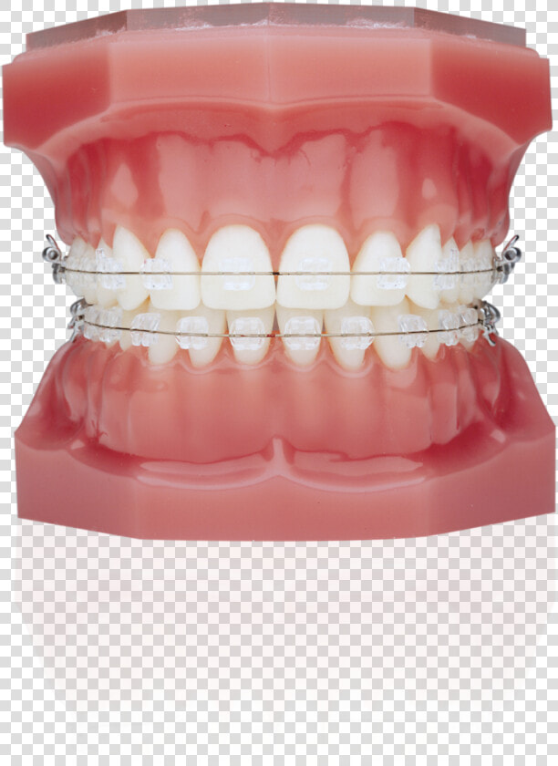 Typodont With Braces  HD Png DownloadTransparent PNG