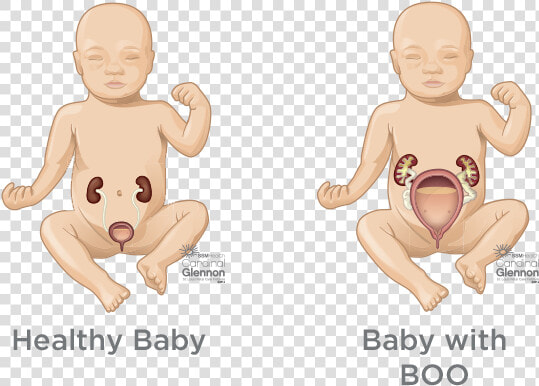 Bladder Outlet Obstruction  HD Png DownloadTransparent PNG