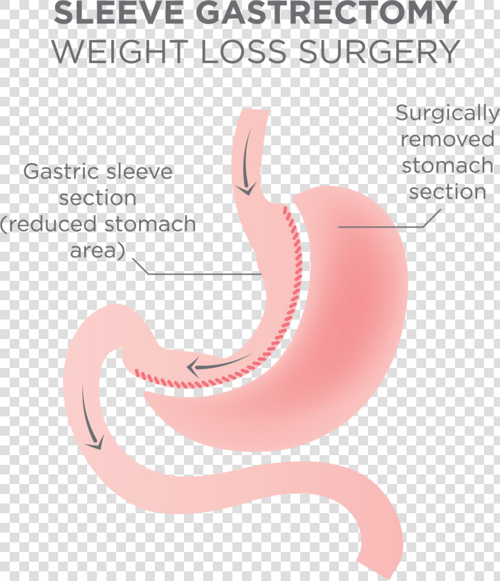 Gastric Sleeve Surgery Procedure   Gastric Sleeve Surgery  HD Png DownloadTransparent PNG