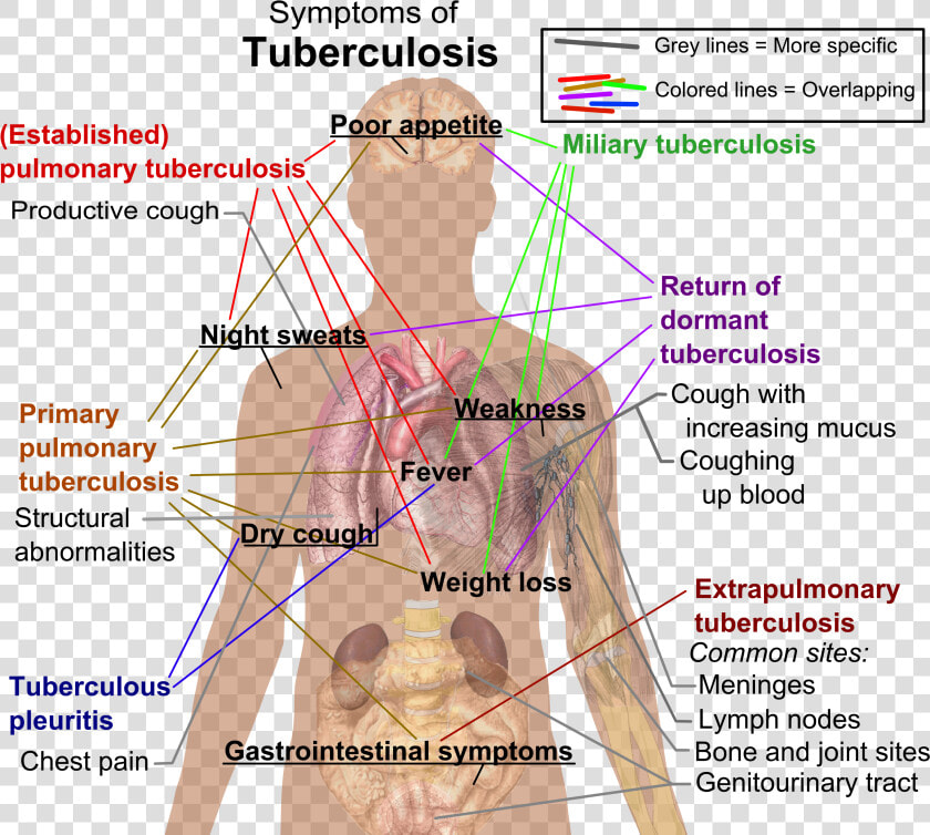 Tuberculosis Symptoms   Symptoms Of Tuberculosis  HD Png DownloadTransparent PNG