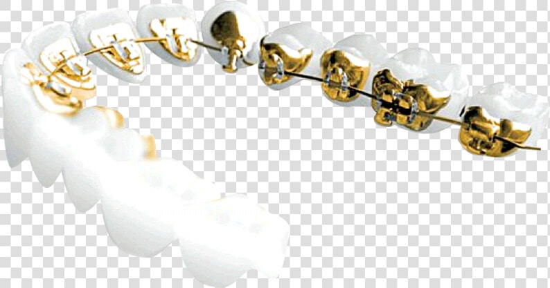 Transparent Gold Teeth Png   Incognito Braces Png  Png DownloadTransparent PNG