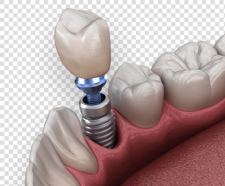 Dental Implants   Implant Dental Png  Transparent PngTransparent PNG