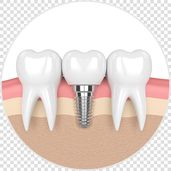 Dental Implant Illustration   Dental Implants  HD Png DownloadTransparent PNG