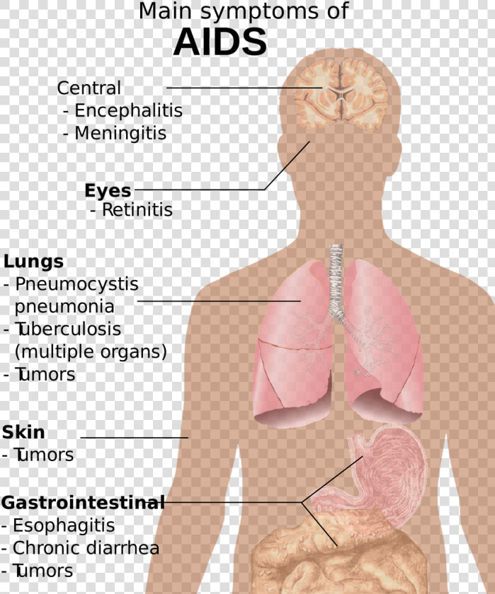 Hiv Aids Png 2 2 Free Photo   Main Symptoms Of Aids  Transparent PngTransparent PNG